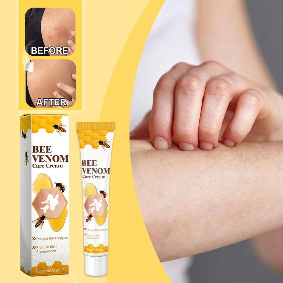 Bee Venom Vitiligo Treatment Cream ( Pack Of 1 )