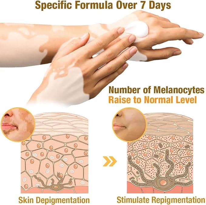 Bee Venom Vitiligo Treatment Cream ( Pack Of 1 )
