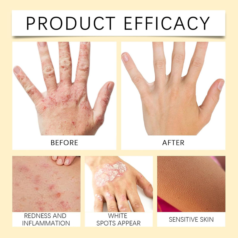 Bee Venom Vitiligo Treatment Cream ( Pack Of 2 )