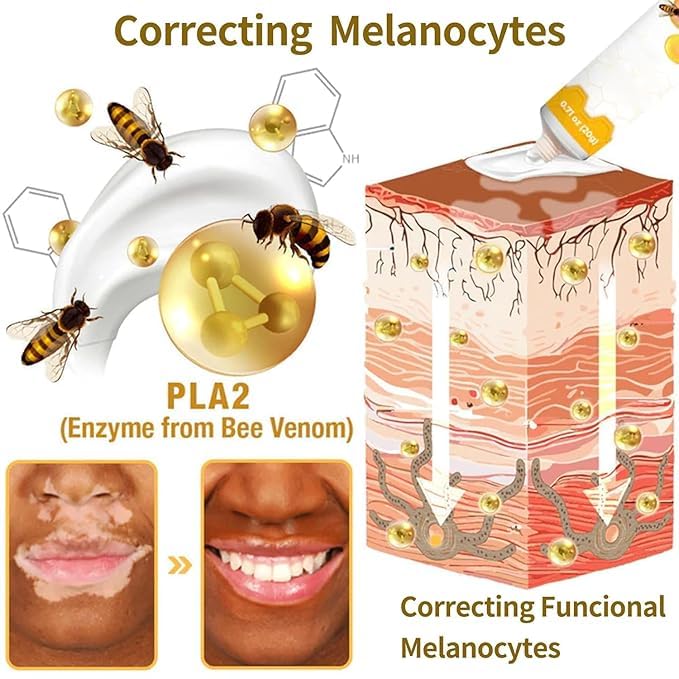 Bee Venom Vitiligo Treatment Cream