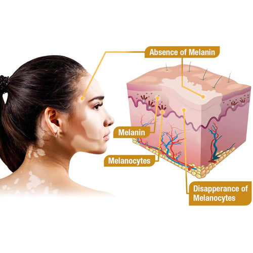 Bee Venom Vitiligo Treatment Cream, Fivfivgo Vitiligo Treatment Cream, Bee Venom Treatment Cream (1PC)