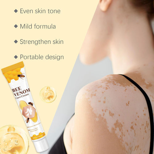 Bee Venom Vitiligo Treatment Cream