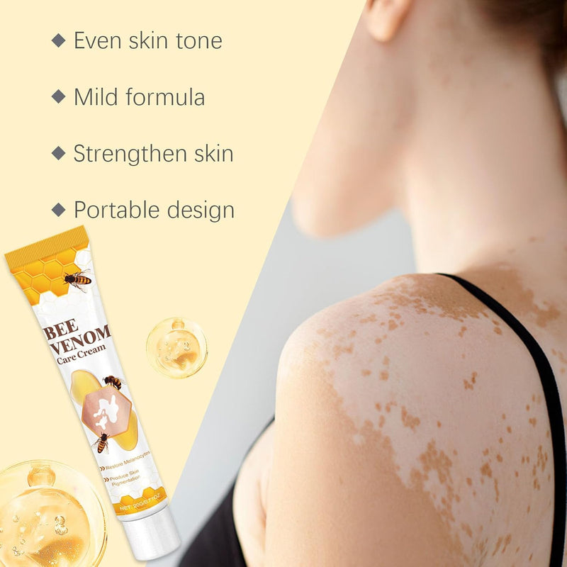 Bee Venom Vitiligo Treatment Cream