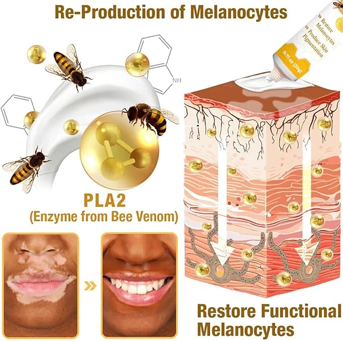 Vitiligo Bee Venom Treatment Cream (PACK OF 1)