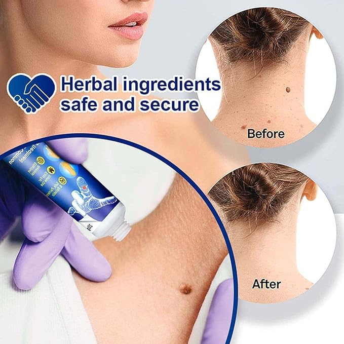 Warts Removal Cream (Pack of 2)